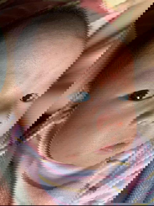 ผดผื่นบนใบหน้า