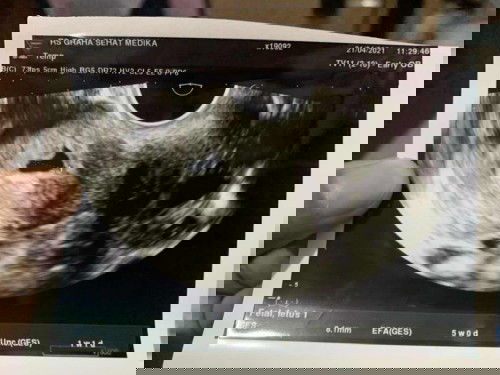 Kehamilan 5 week kantung berbentuk tidak beraturan