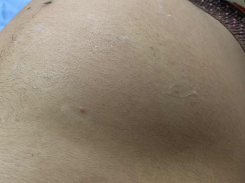 สอบถามถ้าขึ้นผื่นแบบนี้เป็นไรมั้ยคะ