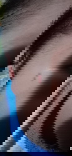 Insect Bite
