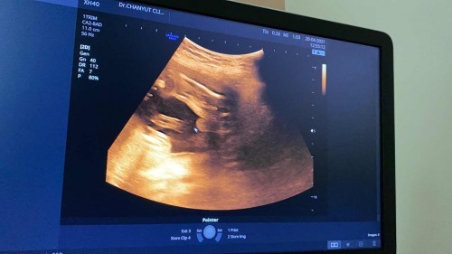 20week ไข่ใหญ่มากกก