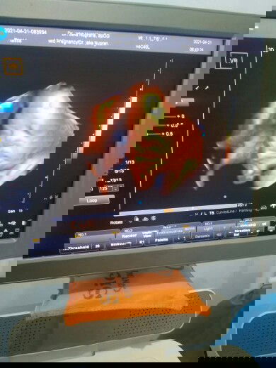 Usia 33wk..Bb 2.5 smoga baik²saja tanpa halangan sampai hari H sehat ibu dan bayi nya ..