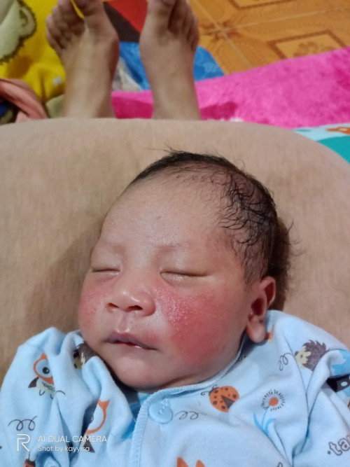 Ruam kulit bayi