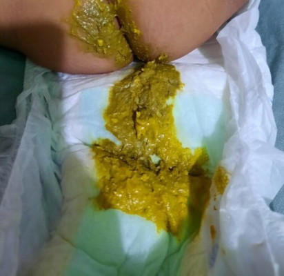 Bayi kerap buang air besar