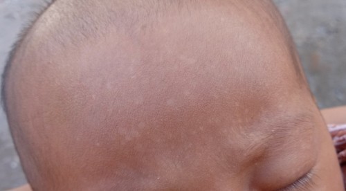 Bercak putih pada kening bayi