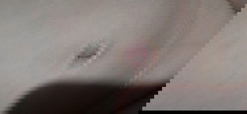 Udel(Tali pusar) 4bulan masih merah . Apa solusinya?