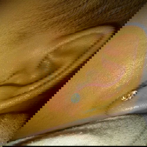 ruam di bawah telinga