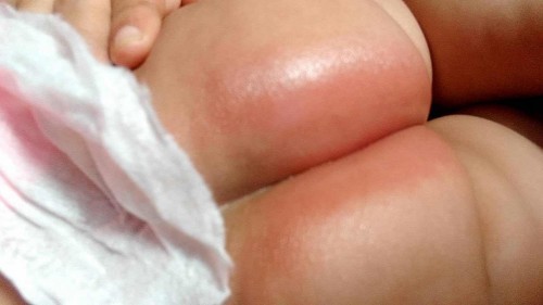 สอบถามเรื่องอาการไม่สบายของลูกหน่อยค่ะ