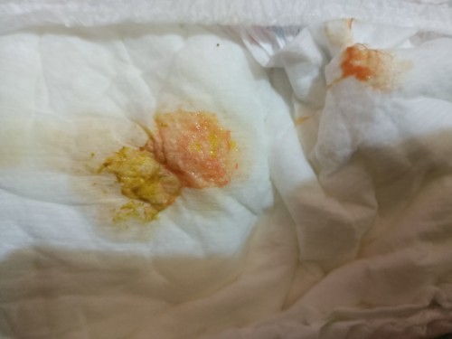 ถ่ายเป็นเลือด