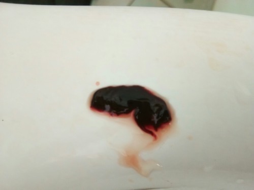 แท้งคุกคาม