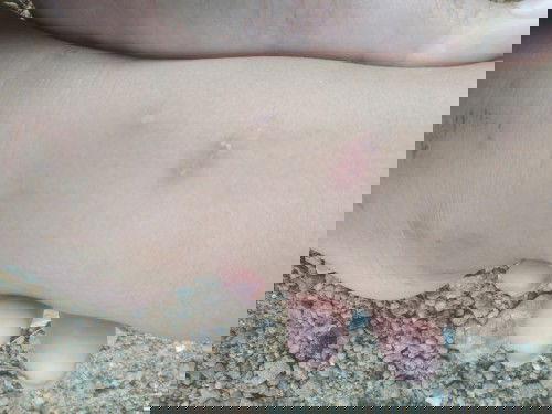 ตุ่มคัน ผื่นคัน