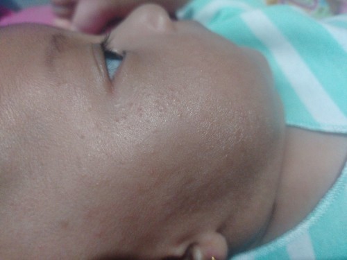 Kulit wajah bayi kering