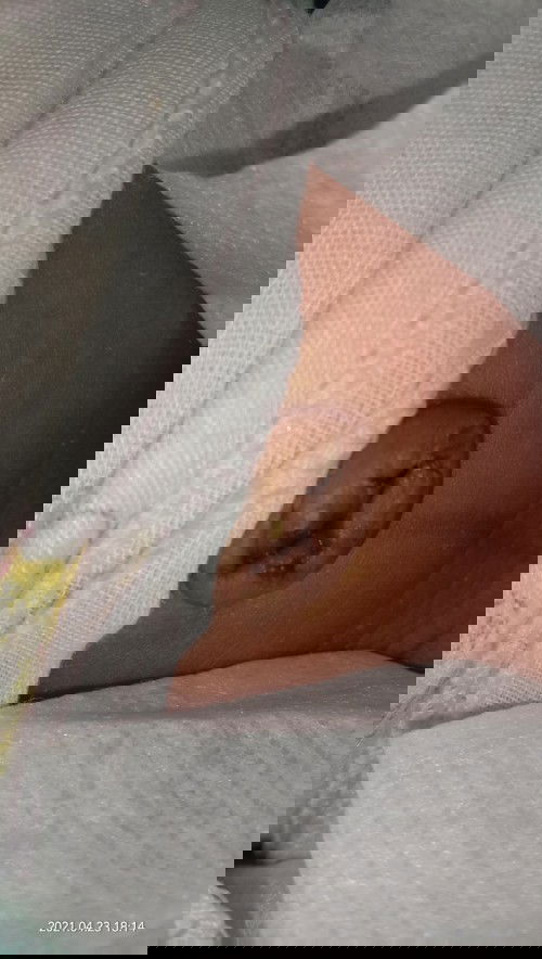 mengatasi puser nonjol