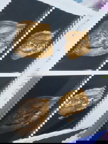 Cairan lebih di tengkuk leher janin