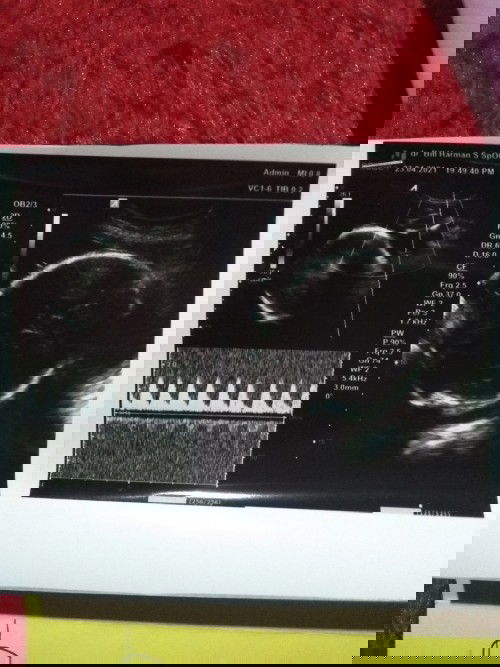 33 minggu masih sungsang