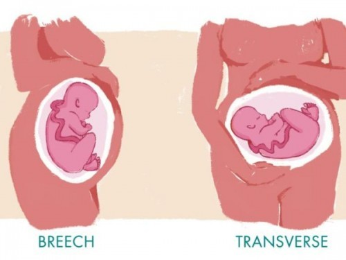 27 weeks & 1day na ako mga mamsh nalaman ko sa OB ko na Nkatransverse si baby ko iikot pa kya siya?.