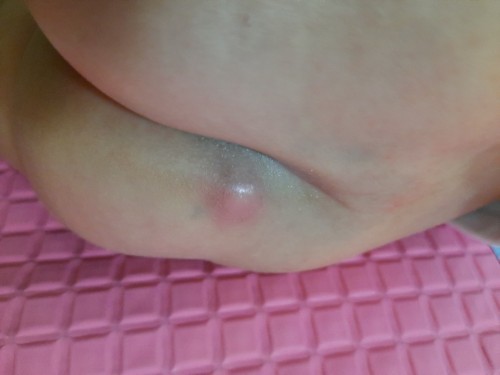 Insect bite or pigsa?
