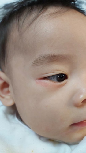Allergy? Help kung mron sa mga baby nyo na meron ganito.