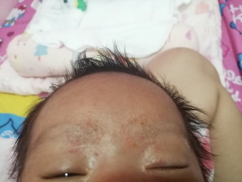 Baby acne 25days old