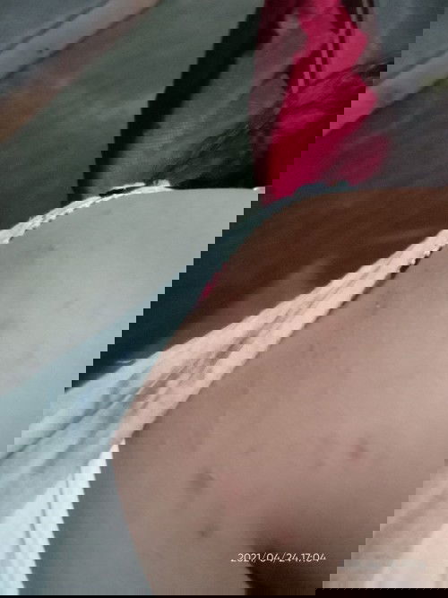 Kulit gatal pasca melahirkan