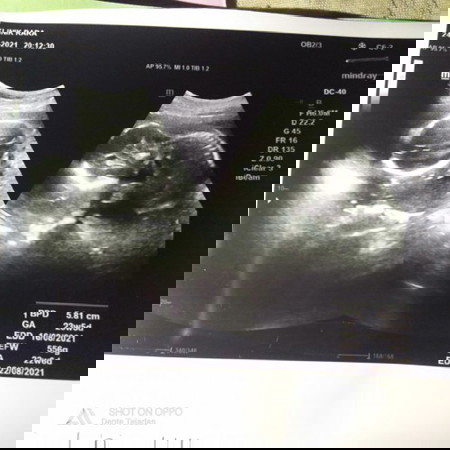 Bingung...perkiraan lahir menurut http 8desrmber,tpi liat hasil usg,,hpl nya 22agustus