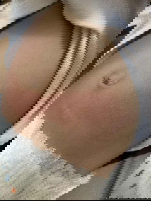 Bayi bentol dan ruam