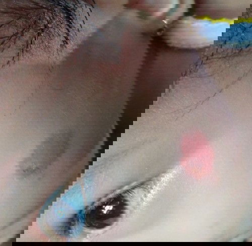 eksim di pipi bayi 7 bulan