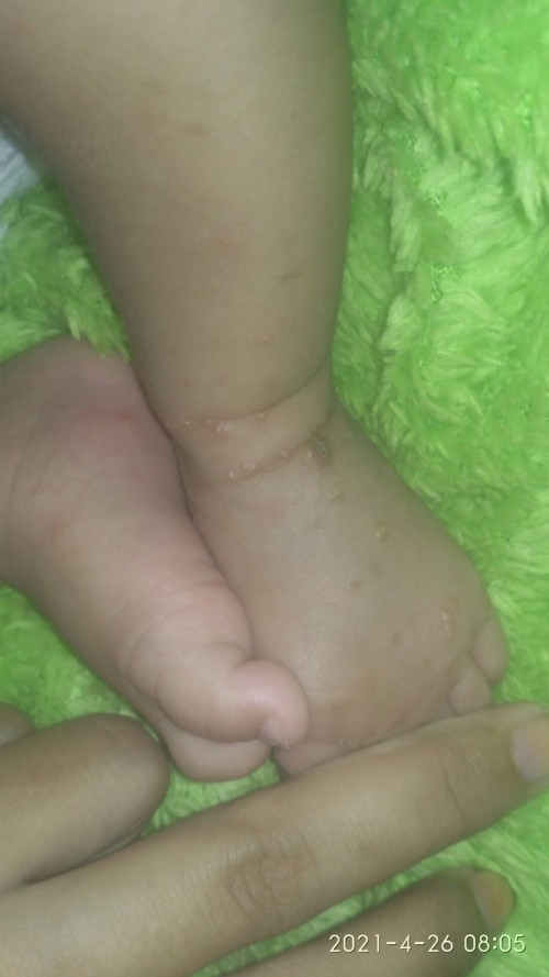 Melenting pada bayi