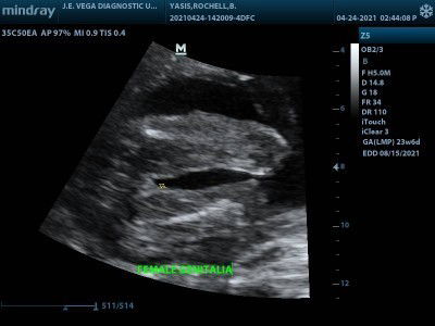 Baby Girl through Through Congenital Anomaly Scan, may chance ba na magkamali gender ni baby?