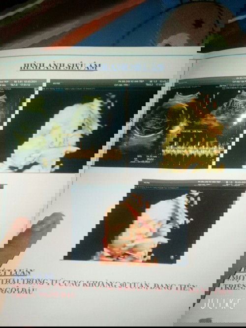 Cho em hỏi mũi bé z có cao không ạ