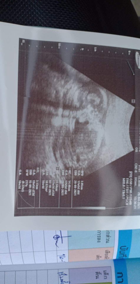 ขออนุญาตสอบถามแม่ๆหน่อยค่ะ อันนี้ไม่รู้จริงๆค่ะ #ท้องแรก