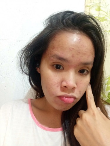 Help mommies, pimple breakouts