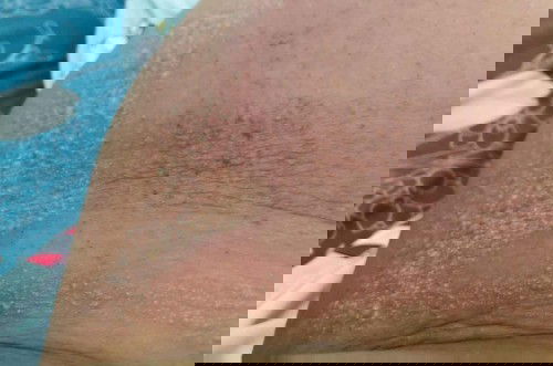 Gatal pada perut dan bernanah