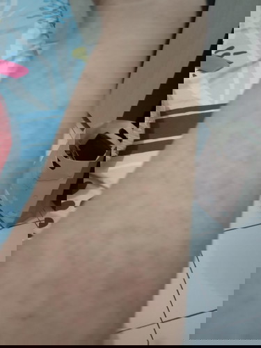 Kulit bentol ² merah pasca melahirkan Caesar