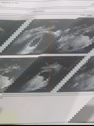 ไปซาว วันนี้หมอแจ้งว่าท้องลมให้ยุติการตั้งครรภ์  ทำตัวไม่ถูกค่ะงงไปหมด รอเค้ามานาน ท้อใจเลย