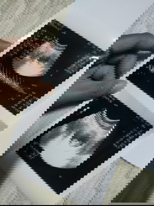 ท้องได้ 3 เดือนแล้วค่ะกินอะไรก็อ้วกไม่กินก็อ้วกค่อนข้างแพ้เยอะค่ะ แพ้จนต้องไปนอนโรงพยาบาลให้น้ำเกลือ