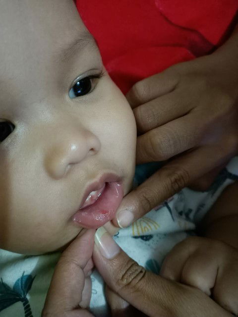 Bayi 1 tahun sariawan