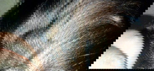 Rambut anak tiba tiba rontok