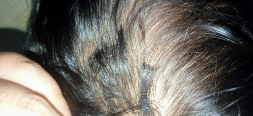 Rambut anak tiba tiba rontok