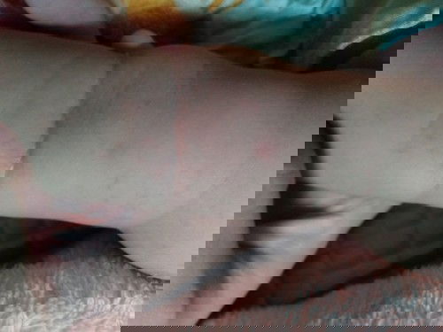 Con bé nhà e nó nổi mẩn đỏ như vậy