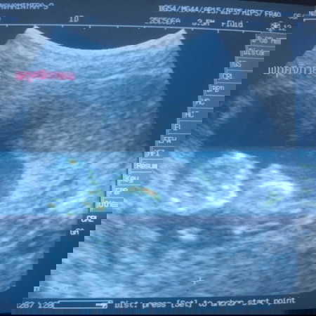 ซาวน์ตอน 11w5d ขอสอบถามหน่อยค่ะ มือใหม่อย่าว่ากันนะคะ??