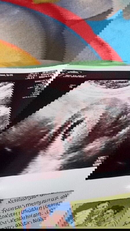Usg Pertama di Kehamilan Pertama