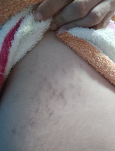 แม่ๆท่านไหนมีอาการซ้ำและปวดบริเวณสะโพกบ้างไหมค่ะ?