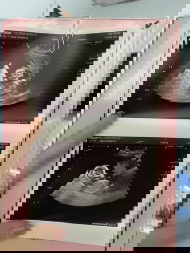 อัลตราซาวด์ครั้งที่ 3