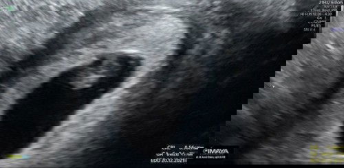 HPHT 16 Februari, usg hari ini GA 6w, CRL 0.56cm. Belum kedengeran denyut jantung. Normal kah???