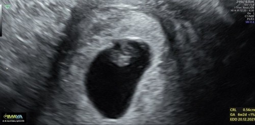 HPHT 16 Februari, usg hari ini GA 6w, CRL 0.56cm. Belum kedengeran denyut jantung. Normal kah???