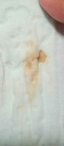 แชร์ประสบการณ์ภาวะแท้งคุกคาม