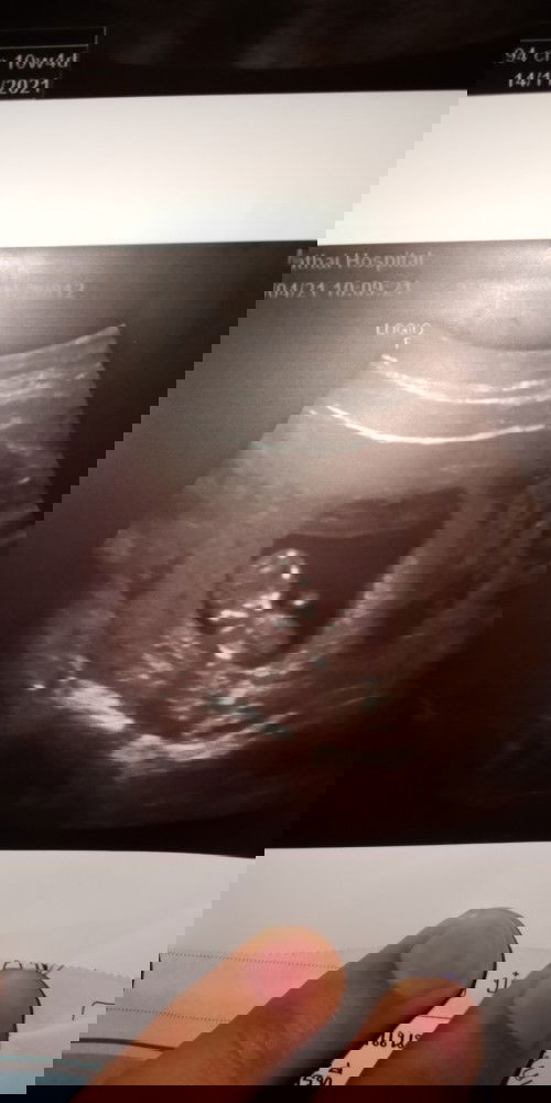 อายุครรภ์กับตัวน้องไม่สอดคล้องกัน