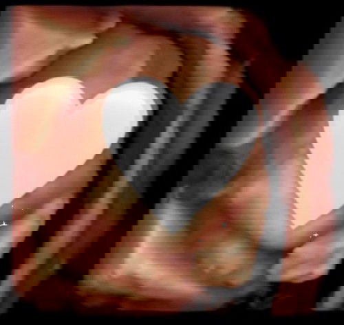 Tali pusat belit leher baby