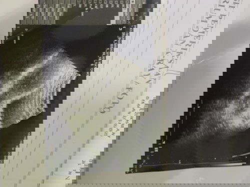 Pendarahan, test pack positif, Hasil USG penebalan dinding rahim